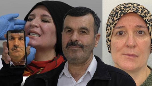 Çene ağrısı çekip, yüz asimetrileri bozulmuştu... Sebebini öğrenince hayatlarının şokunu yaşadılar: İnsan içine çıkamıyordum