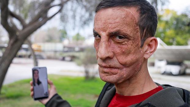 Türkiye'nin ilk yüz nakli ona yapılmıştı... Donörün kızı ile duygulandıran görüşme: 'Babamın yüzü Uğur'da yaşıyor'