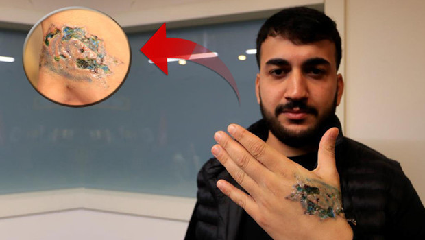 Dövme sildirmek isteyen genç kabusu yaşadı, elindeki dokular öldü