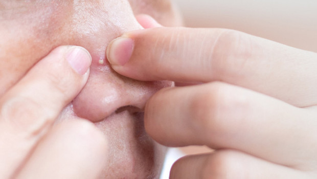 Sivilce sıkmak tehlikeli mi? Sosyal medyada görüp denemeyin